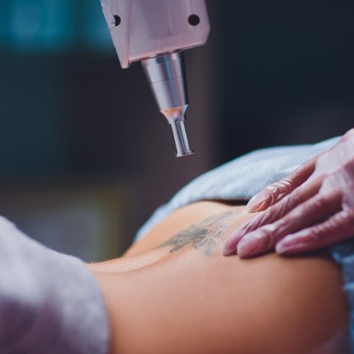 Eliminación de tatuajes en Asturias
